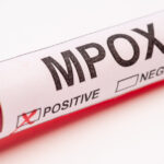 sua confirma primul sau pacient cu noua forma de mpox 673913a03a36b