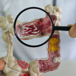 tot mai multe cazuri de cancer intestinal depistate la tineri care sunt cauzele 675f4844b3558
