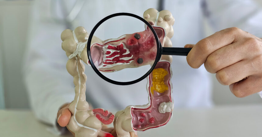 uleiurile de gatit ar putea provoca o crestere a cazurilor de cancer colorectal in randul tinerilor avertizeaza medicii 675c11c2594b0