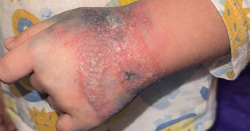 ancheta la spitalul ramnicu valcea dupa imaginile cu un copil cu mana tumefiata din cauza unei branule neschimbate de 4 zile 679b723d10d0c