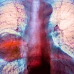 diagnosticele de cancer pulmonar sunt in crestere in randul persoanelor care nu fumeaza niciodata 67a1d185b70a7