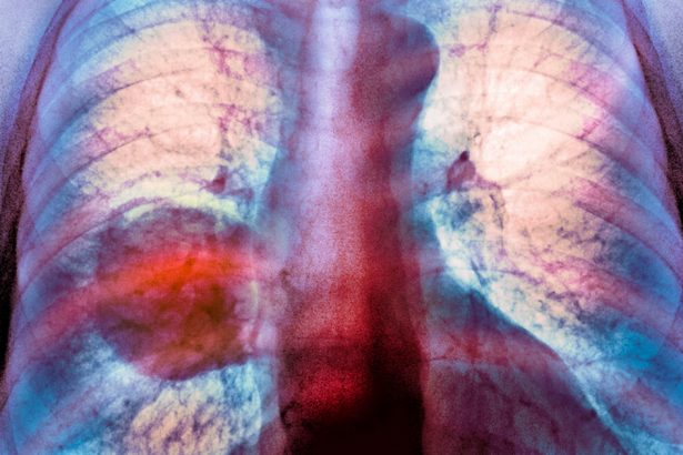 diagnosticele de cancer pulmonar sunt in crestere in randul persoanelor care nu fumeaza niciodata 67a1d185b70a7
