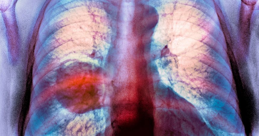 Diagnosticele de cancer pulmonar cresc în rândul persoanelor care nu au fumat niciodată. 1 diagnosticele de cancer pulmonar sunt in crestere in randul persoanelor care nu fumeaza niciodata 67a1d185b70a7