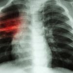 crestere alarmanta a cazurilor de tuberculoza la copii in europa si asia centrala oms cere masuri imediate 67e12b4921fa6