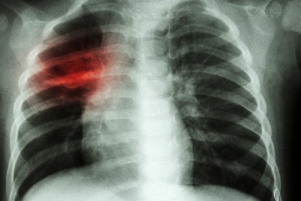 crestere alarmanta a cazurilor de tuberculoza la copii in europa si asia centrala oms cere masuri imediate 67e12b4921fa6