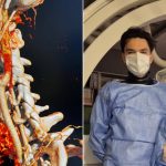premiera medicala in romania prima embolizare arteriala tiroidiana realizata la spitalul universitar de urgenta bucuresti 67d1bf4814037