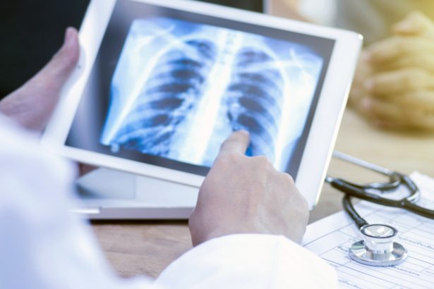 video pacientii nu isi recunosc simptomele tuberculoza face mii de victime in romania insa putini dintre bolnavi ajung la timp la medic 67e2523076bdd