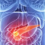 Un nou test ar putea identifica cancerul pancreatic în stadiile timpurii. 3 un nou test ar putea depista cancerul pancreatic in stadiile initiale 6851c38f17988