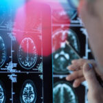 Un medicament pentru tratarea bolii Alzheimer în stadii timpurii este aproape de autorizare în UE: informații despre donanemab. 3 un medicament pentru tratarea bolii alzheimer in stadii timpurii este aproape de autorizare in ue ce este donanemab 68861b96ed40c