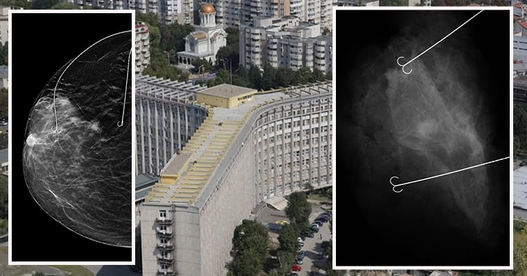 Premieră medicală în patologia mamară la Spitalul Clinic Județean de Urgență din Constanța 1 premiera medicala in patologia mamara la spitalul clinic judetean de urgenta constanta 6893685bde989