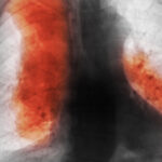 numarul deceselor cauzate de cancer ar urma sa creasca semnificativ pana in 2050 cele mai frecvente si cele mai mortale studiu 68d500d29a5c7