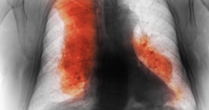 numarul deceselor cauzate de cancer ar urma sa creasca semnificativ pana in 2050 cele mai frecvente si cele mai mortale studiu 68d500d29a5c7