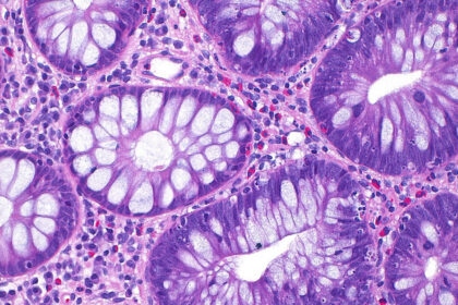cum a ajuns cancerul de colon sa afecteze tot mai multi tineri si care este cauza principala indicata de studii 68eaca8c457e8