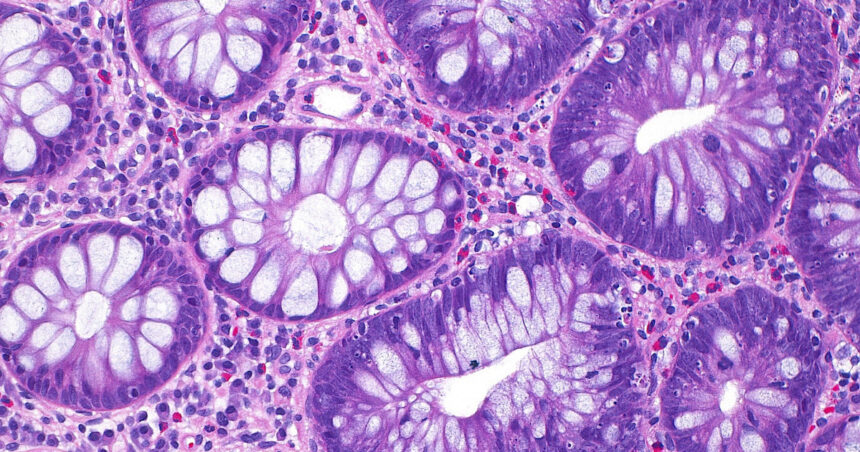 cum a ajuns cancerul de colon sa afecteze tot mai multi tineri si care este cauza principala indicata de studii 68eaca8c457e8