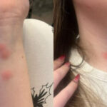 video o tanara a ajuns la spital dupa ce a fost muscata de plosnite intr un tren cfr familia a facut plangere 6922d3f4a59de