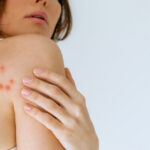 cum recunosti muscatura de plosnita medicii explica riscurile pentru sanatate poate declansa reactii alergice puternice 6933e95183cc5