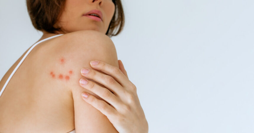 cum recunosti muscatura de plosnita medicii explica riscurile pentru sanatate poate declansa reactii alergice puternice 6933e95183cc5