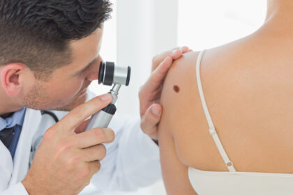 cum identifici alunitele cu risc de cancer dermatologii explica semnele importante care necesita evaluare urgenta 697482eed598d