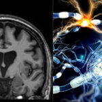 studiu covid 19 poate lasa modificari detectabile in creier chiar si dupa recuperare completa 6957541b01d56