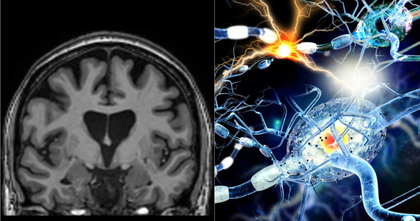studiu covid 19 poate lasa modificari detectabile in creier chiar si dupa recuperare completa 6957541b01d56
