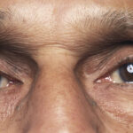 o bacterie prezenta in ochi asociata cu boala alzheimer si declinul cognitiv arata un nou studiu 69879d09f0461