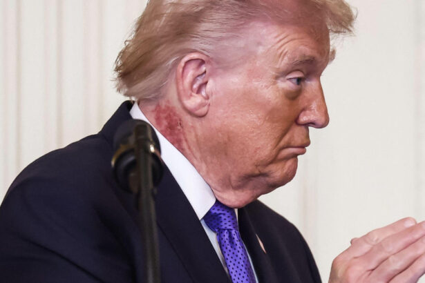 noi intrebari despre starea de sanatate a lui donald trump ce este pata rosie aparuta pe gatul presedintelui american 69a6086430fc3