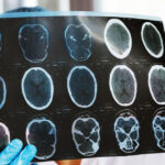 asociatiile de pacienti cer interventia ministerului sanatatii si cnas dupa scaderea cu 47 a investigatiilor de monitorizare 69cf92eeb9c84